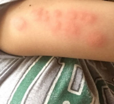 Bed bug bites