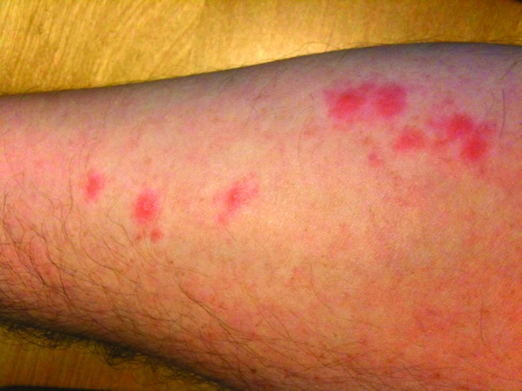 bed bug infestations can cause bites like these!