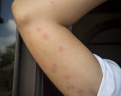 what bed bug bites look like on an arm